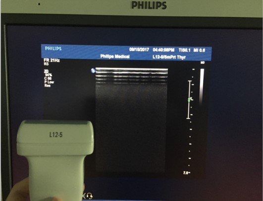 Philips L12-5 Sound Head Replacement