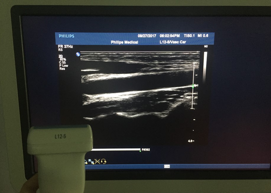 Philips L12-5 Sound Head Replacement